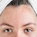 Wajah Beruntusan Di Akibat Kurang Menjada Kulit Secara Benar