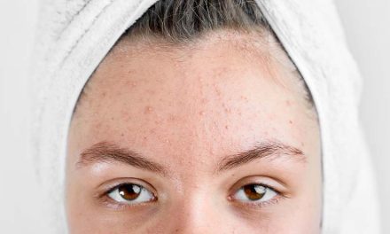 Wajah Beruntusan Di Akibat Kurang Menjada Kulit Secara Benar