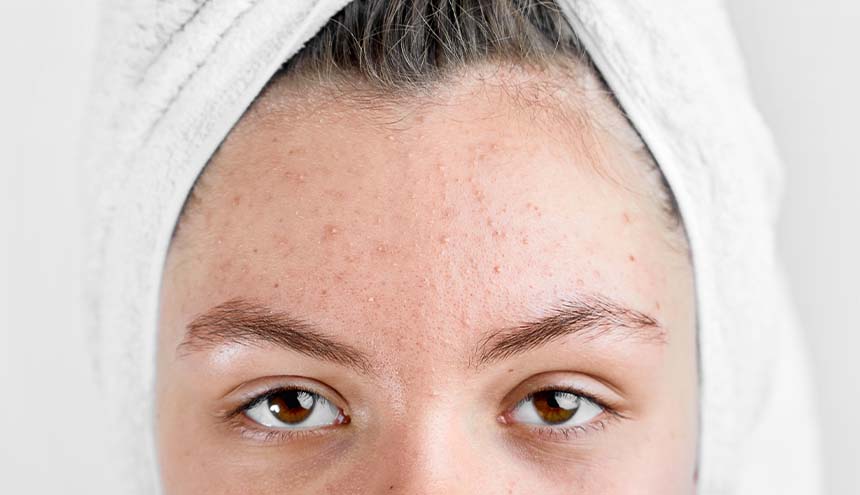 Wajah Beruntusan Di Akibat Kurang Menjada Kulit Secara Benar