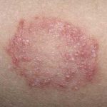 Infeksi Jamur Yang Ada Pada Kulit Menyebabkan Panu