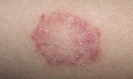 Infeksi Jamur Yang Ada Pada Kulit Menyebabkan Panu