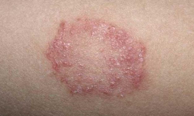 Infeksi Jamur Yang Ada Pada Kulit Menyebabkan Panu