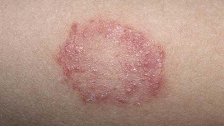 Infeksi Jamur Yang Ada Pada Kulit Menyebabkan Panu